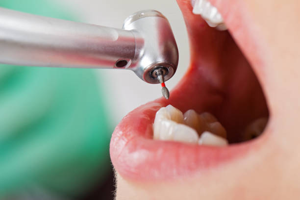 Best Urgent Tooth Repair  in Albany, MO